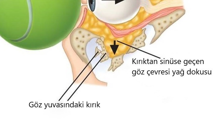 Teniste potansiyel tehlike: Blow Out kırıkları